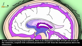 Hydrocephalus