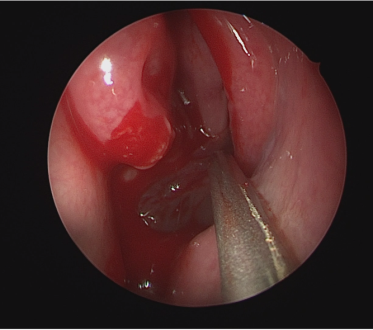 uncinectomy and middle meatal antrostomy