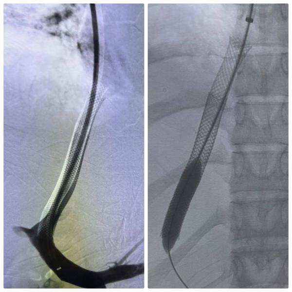 فريق طبي بمستشفى الراجحي بجامعة أسيوط ينقذ حياة فتاة تعاني من فشل كبدي باستخدام الأشعة التدخلية