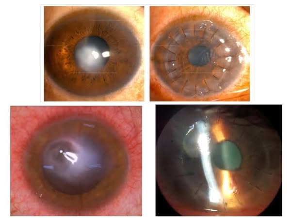 نجاح فريق طبي بقسم طب وجراحة العيون بمستشفيات جامعة أسيوط في إجراء (١٢) عملية ترقيع قرنية ناجحة خلال عام ٢٠٢٤ .