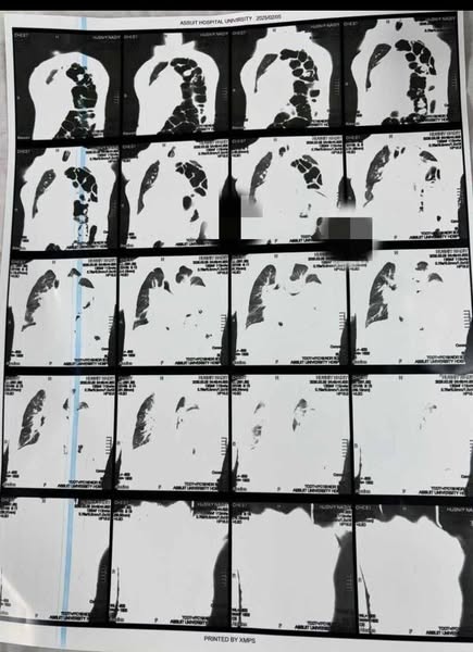 فريق طبى من مستشفيات جامعة أسيوط ، ينجح في انقاذ مريض في العقد الخامس من عمره ، يعانى من عيب خلقي نادر بالصدر يتسبب في تدهور حالته الصحية.