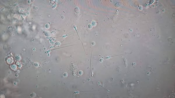 فريق طبي بمستشفى جراحة المسالك البولية والتناسلية بجامعة أسيوط ينجح في علاج مريض يعاني من تأخر الإنجاب باستخدام تقنية الجراحة بالميكروسكوب الضوئي