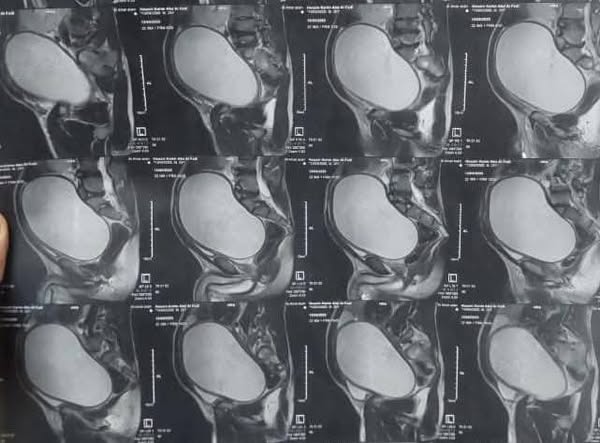 فريق طبي بمستشفى جراحة المسالك البولية والتناسلية بجامعة أسيوط ينجح في إجراء  جراحة معقدة لشاب يعاني من كيس نادر بين المثانة والمستقيم