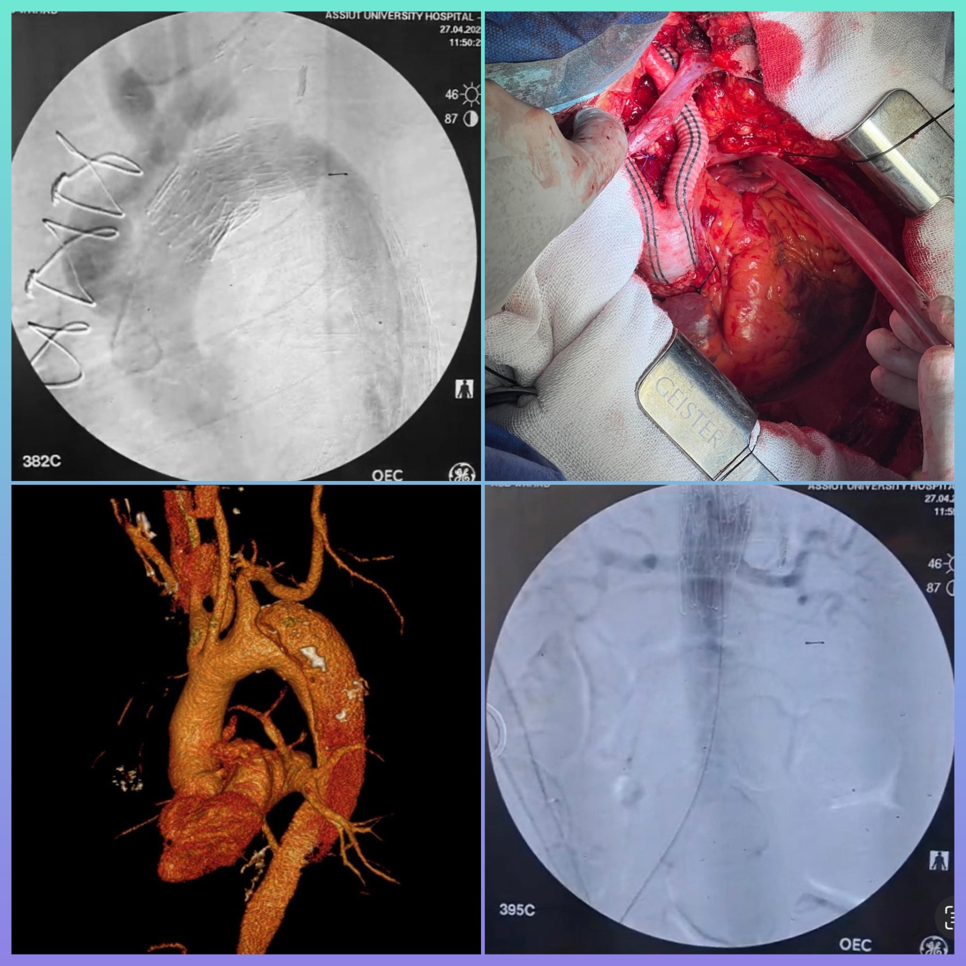 فريق طبي بمستشفيات جامعة أسيوط ينجح في إنقاذ حياة مريض يعاني من انشطار بالشريان الأورطي