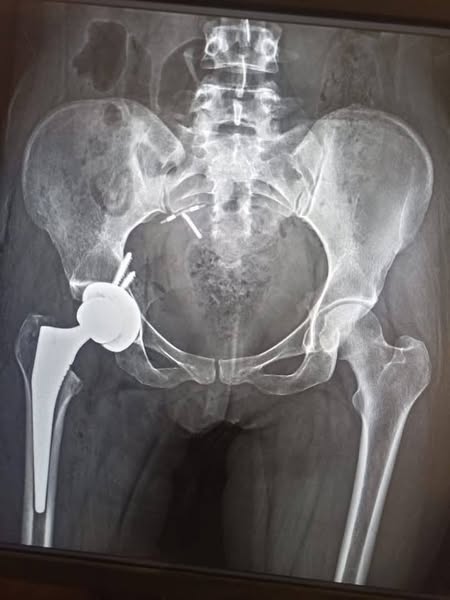 A medical team at Assiut University Trauma Hospital successfully performed a total hip replacement surgery using a cementless total hip arthroplasty using a limited anterior femoral approach for a patient suffering from hip osteoarthritis.