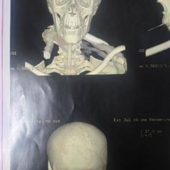 A medical team from the Otorhinolaryngology Department at Assiut University Hospitals succeeds in saving a young man’s life after an iron rod entered his neck.