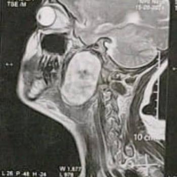 A medical team in the Department of Ear, Nose and Throat Surgery at Assiut University Hospitals succeeds in removing a tumor in the parotid gland extending to the bottom of the skull through a small incision instead of breaking the lower jaw to reach the tumor.
